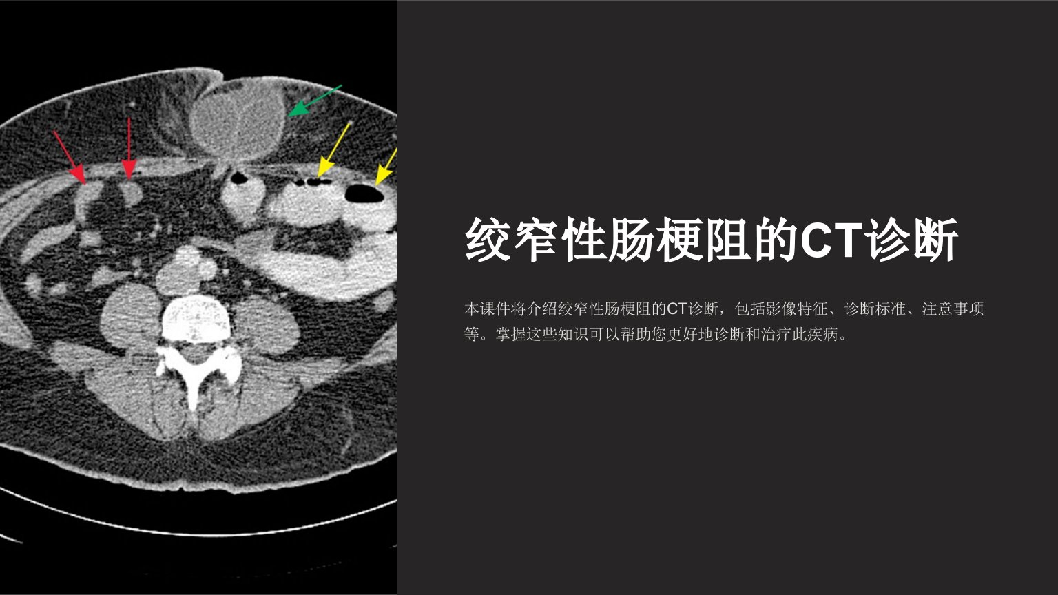 绞窄性肠梗阻的ct诊断课件