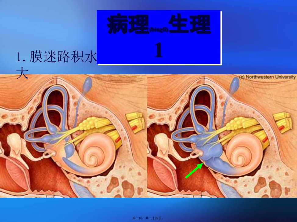 医学专题梅尼埃病七年制