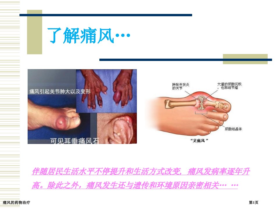 痛风的药物治疗课件PPT