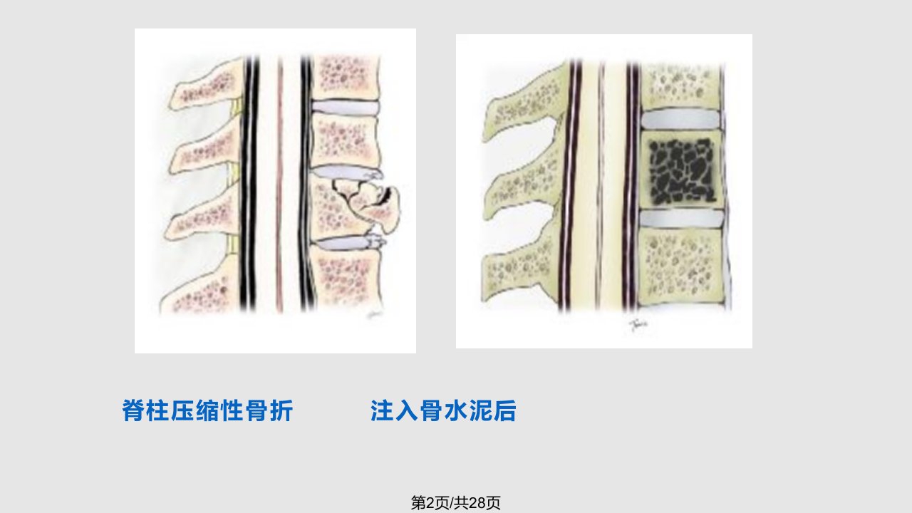 经皮穿刺椎体成形术