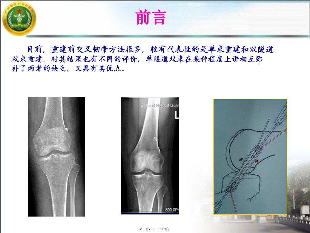 单隧道双束前交叉韧带重建的中期疗效观察