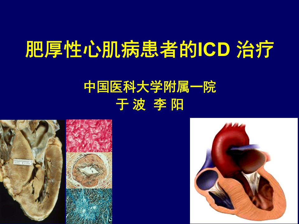 肥厚心肌病患者的ICD治疗中国医科大学附属一院于波李阳教学