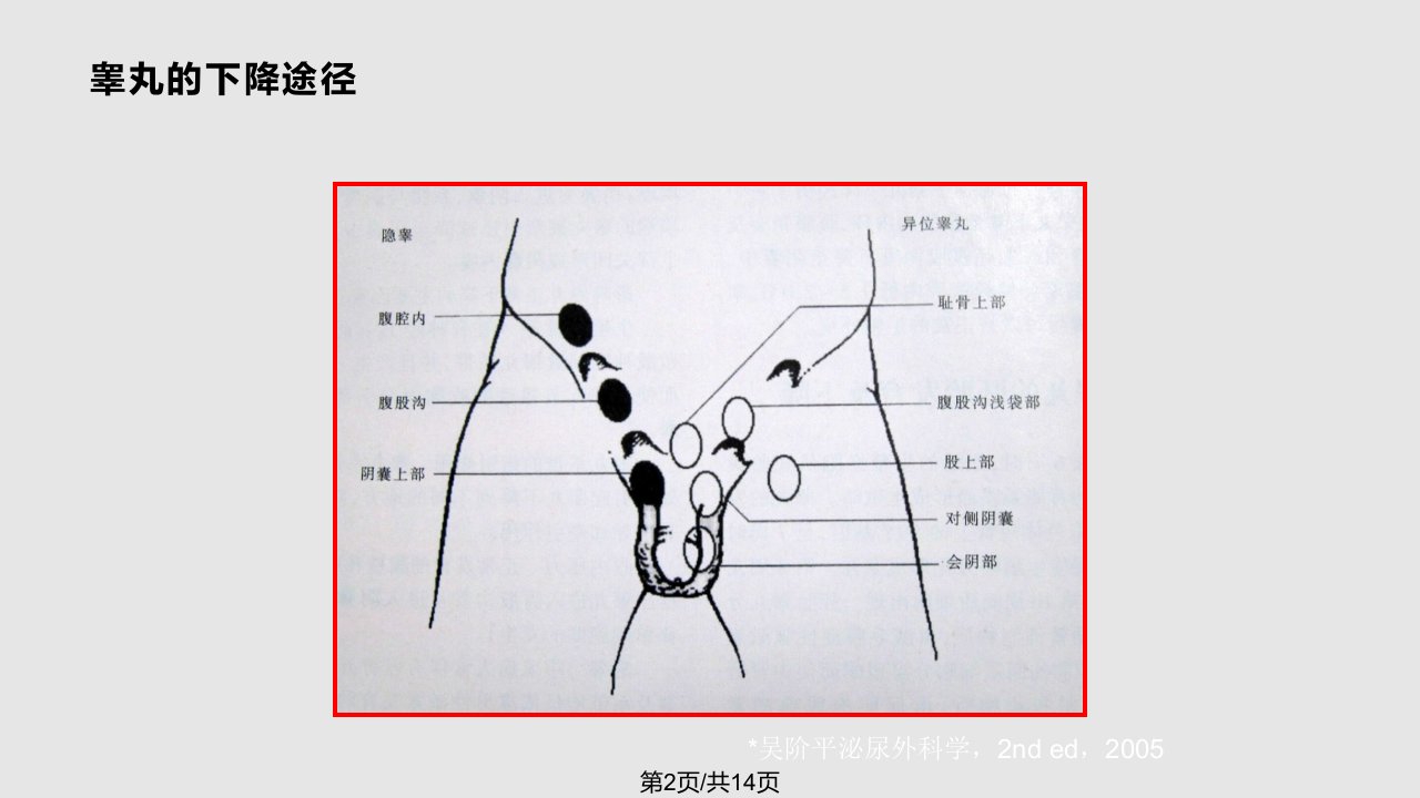 异位睾丸诊治西安系列