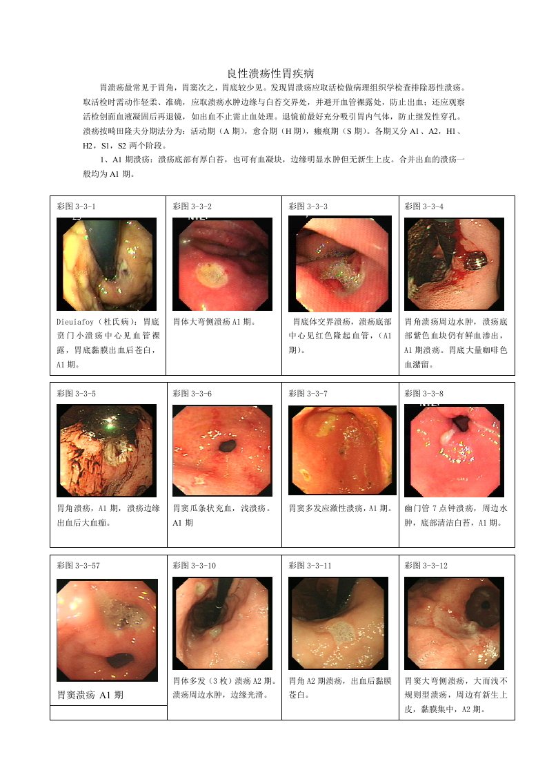 良性溃疡性胃疾病图片