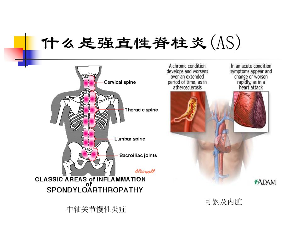 强直性脊柱炎驼背