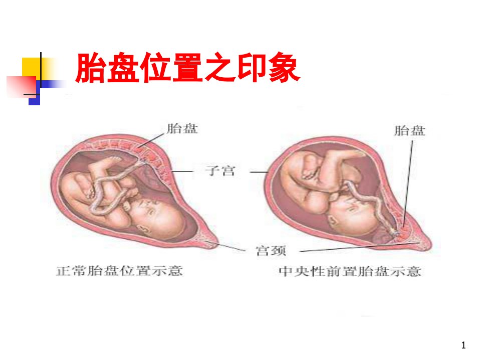 前置胎盘专题培训课件