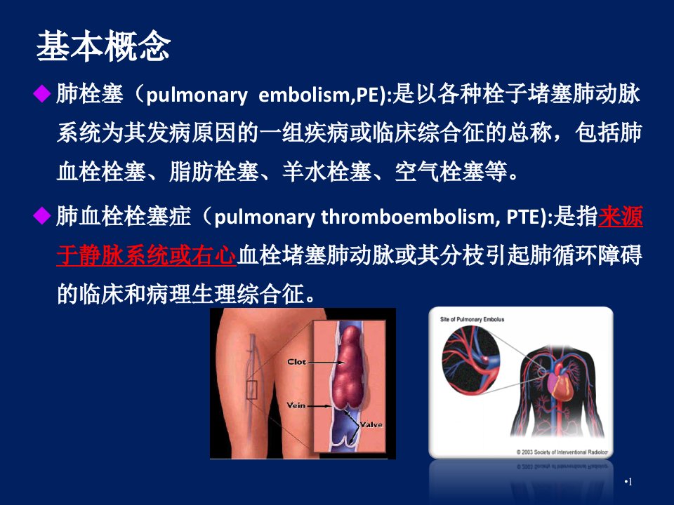 急性肺栓塞诊治及进展PPT课件