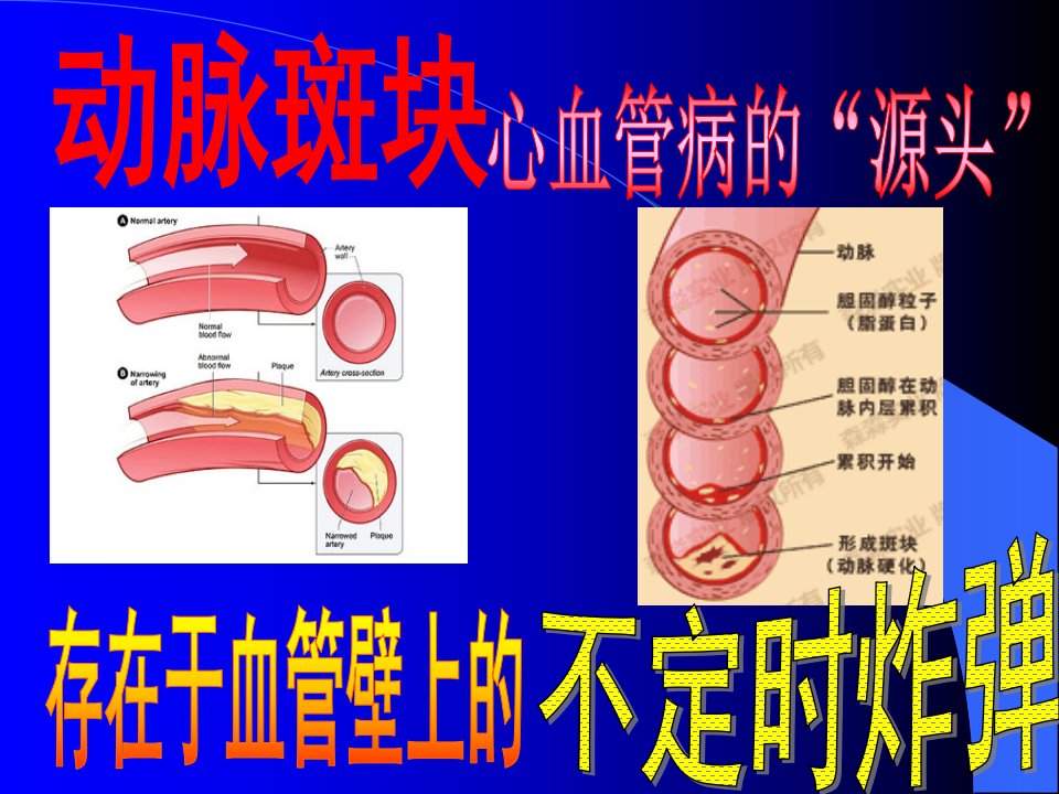 颈动脉斑块专题