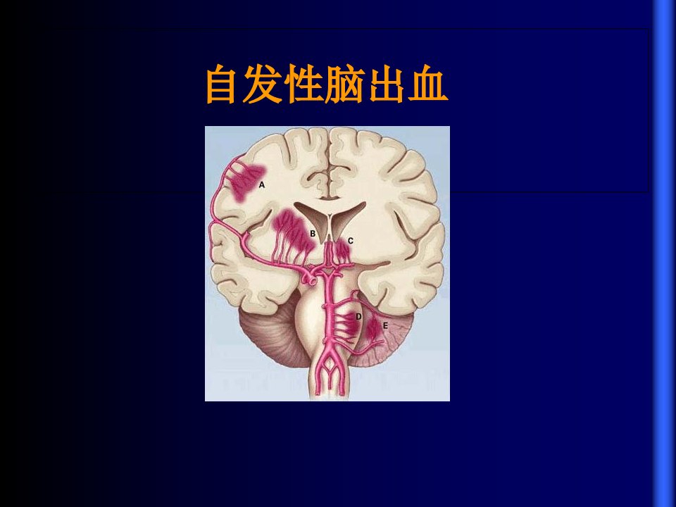 自发性脑出血课件PPT课件