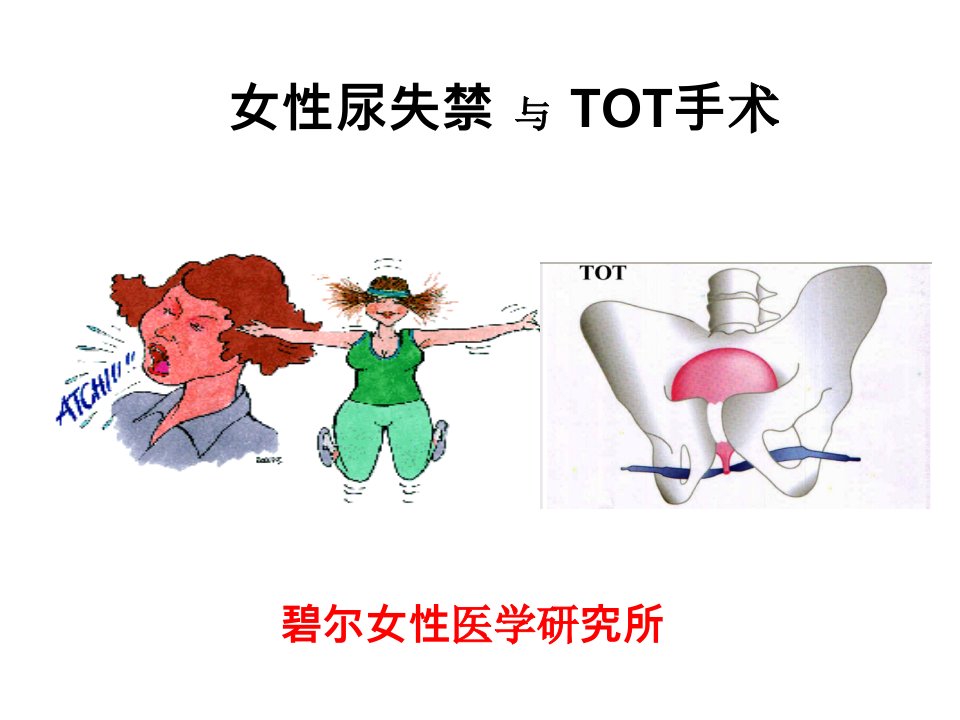 压力性尿失禁TOT治疗