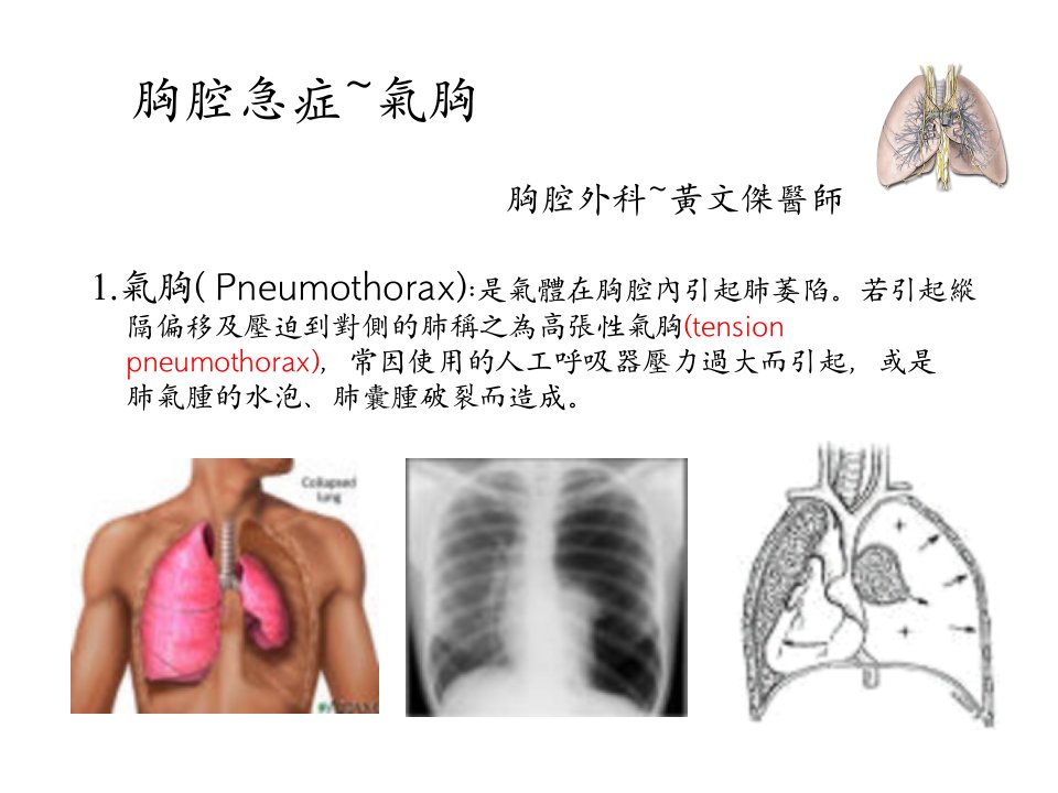 《胸腔急症气胸》PPT课件