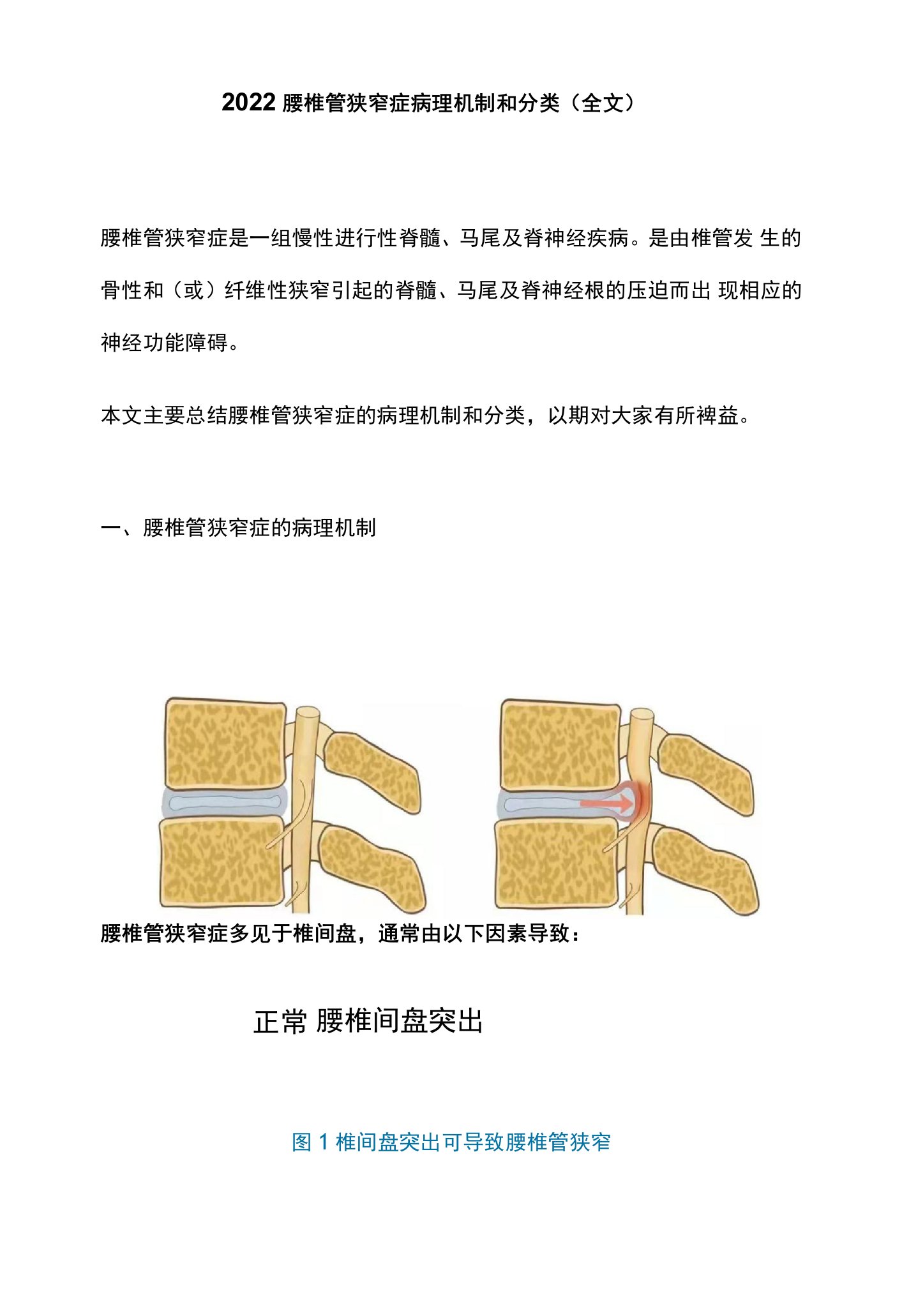 2022腰椎管狭窄症病理机制和分类（全文）