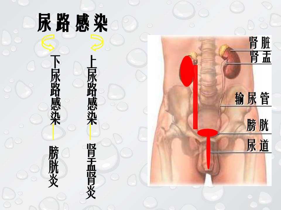 急性肾盂肾炎教程