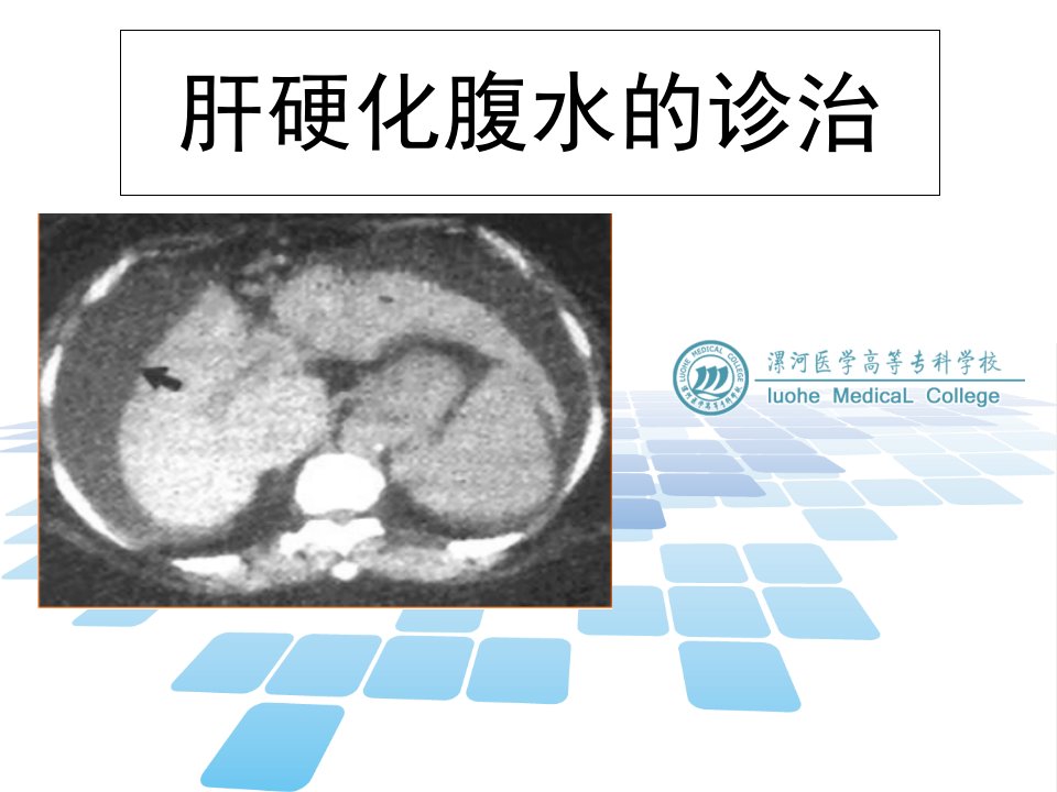 肝硬化腹水的诊治