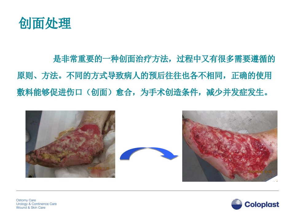 创面处置中敷料的使用PPT讲座