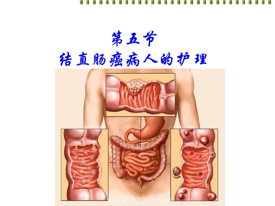 第五节结直肠癌病人的护理