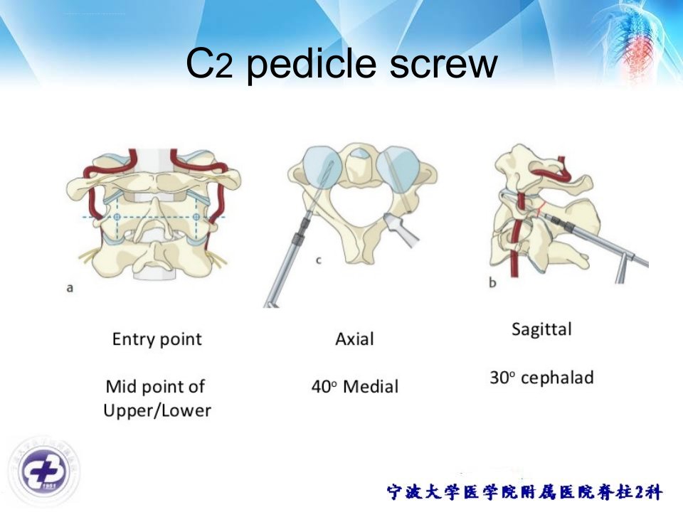 椎动脉高跨和颈2椎板螺钉ppt课件