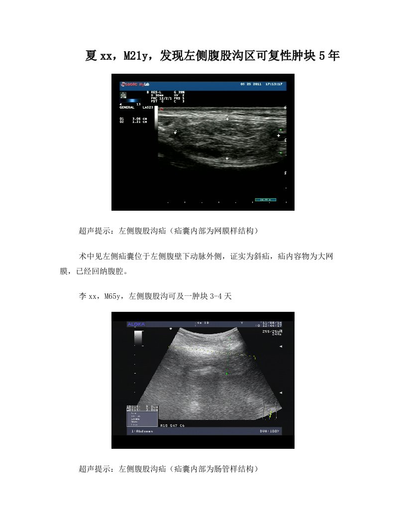 腹股沟疝的超声诊断