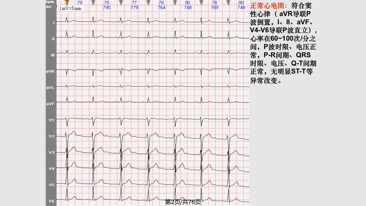 图解常见心电图诊断