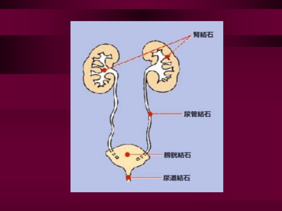 医学课件肾输尿管膀胱结石