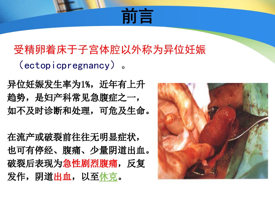 异位妊娠的护理个案分享