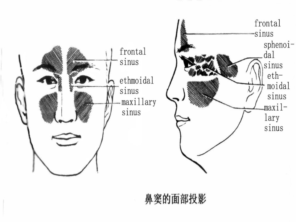 鼻窦炎英文版ppt课件