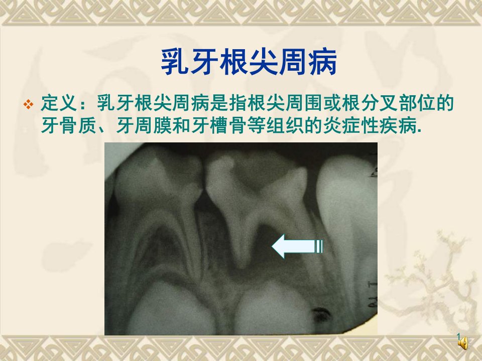 乳牙根尖周病课件