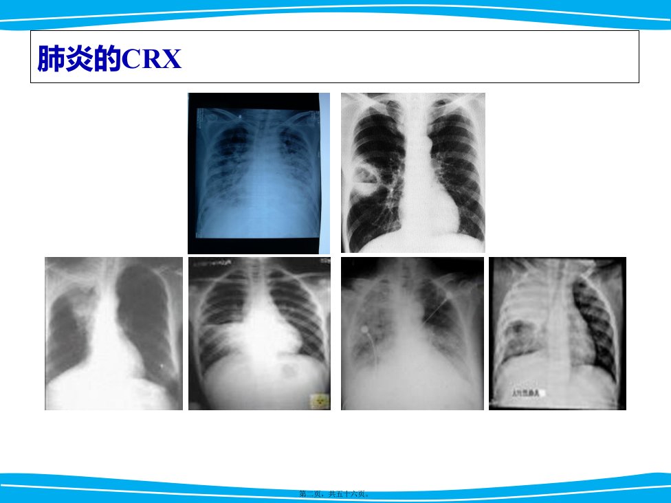 严重肺部感染诊治策略