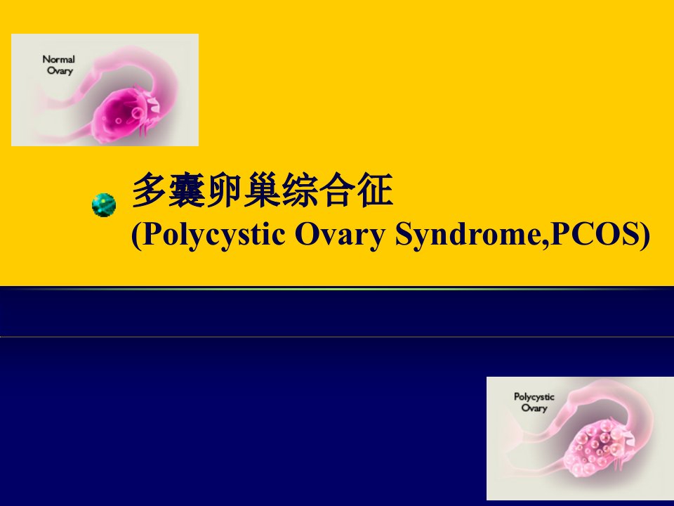 多囊卵巢PPT课件