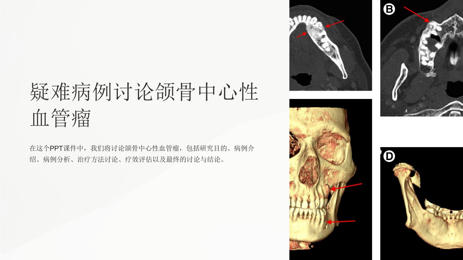 疑难病例讨论颌骨中心性血管瘤课件