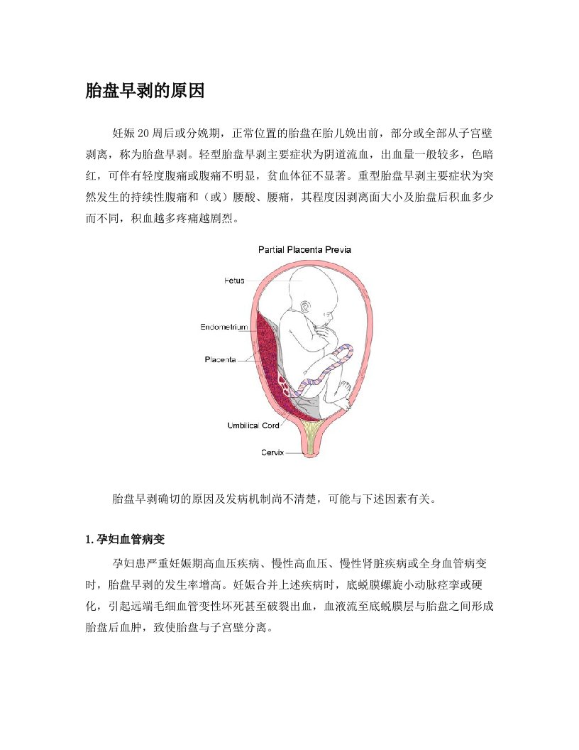 胎盘早剥的原因