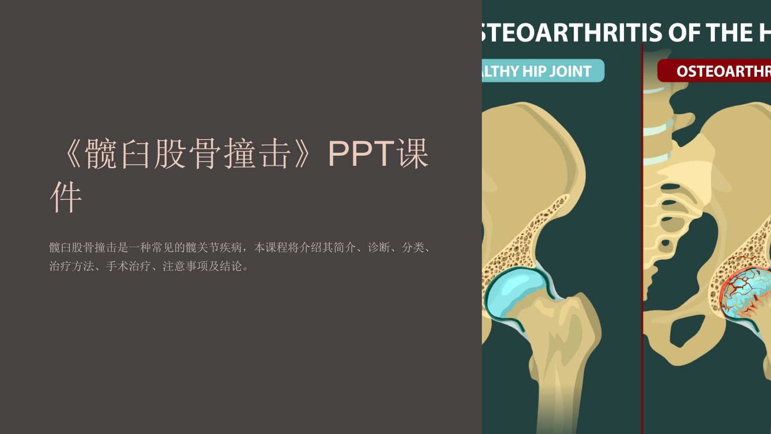 《髋臼股骨撞击》课件