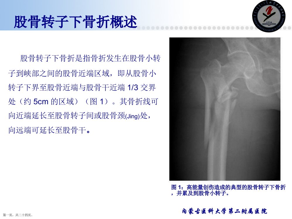 临床综述股骨转子下骨折诊疗进展王喜良