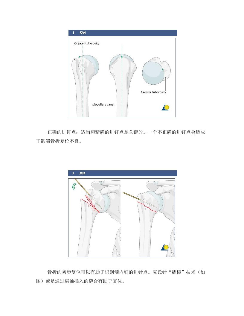 手术-肱骨近端骨折A2型髓内钉固定术