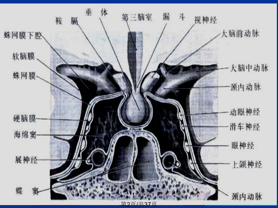 海绵窦综合征