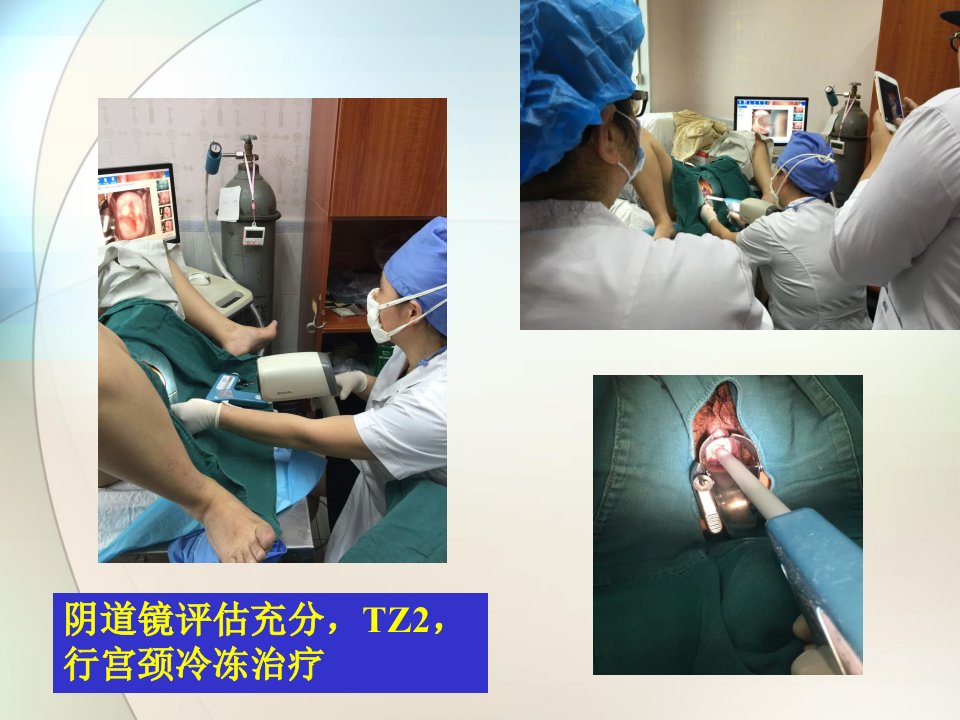 病例323岁G4P0细胞学HSILHPV16阳性宫颈活检12