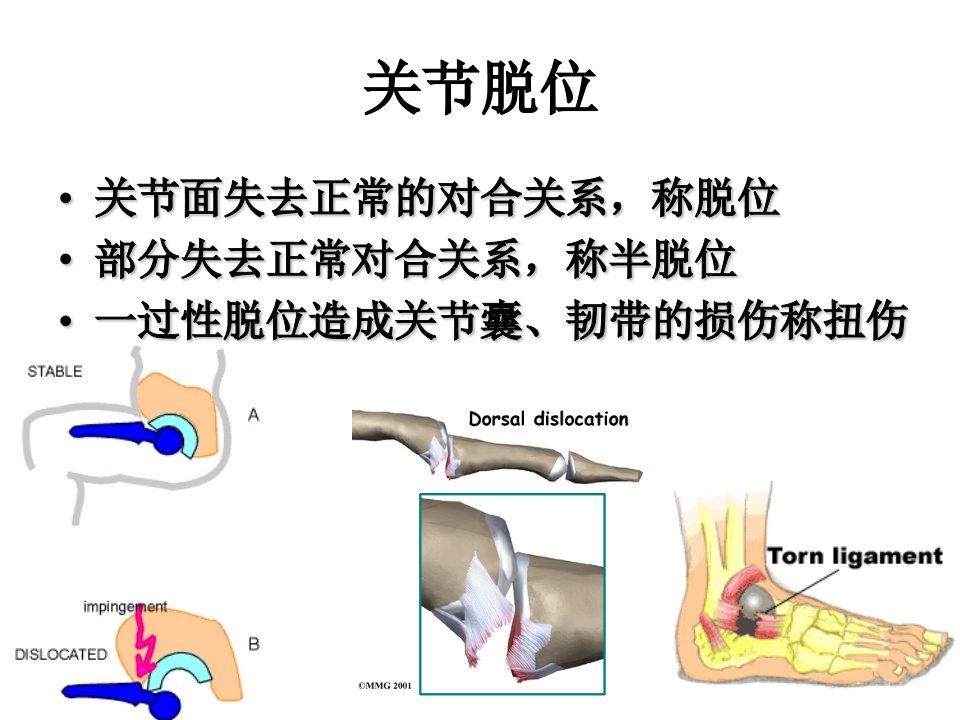 关节脱位PPT课件