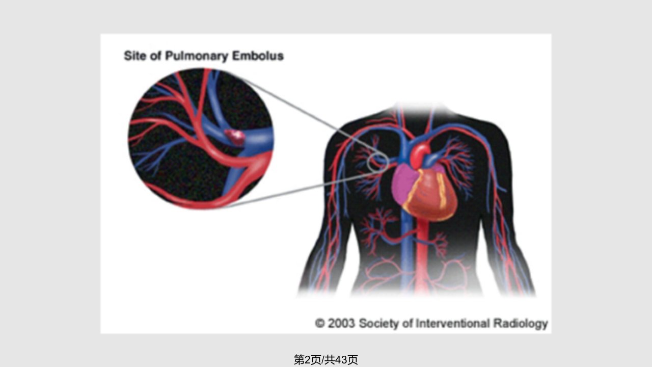 肺栓塞护理查房PPT精