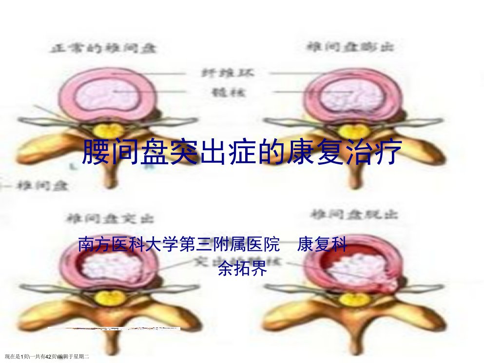 腰椎间盘突出症的康复治疗