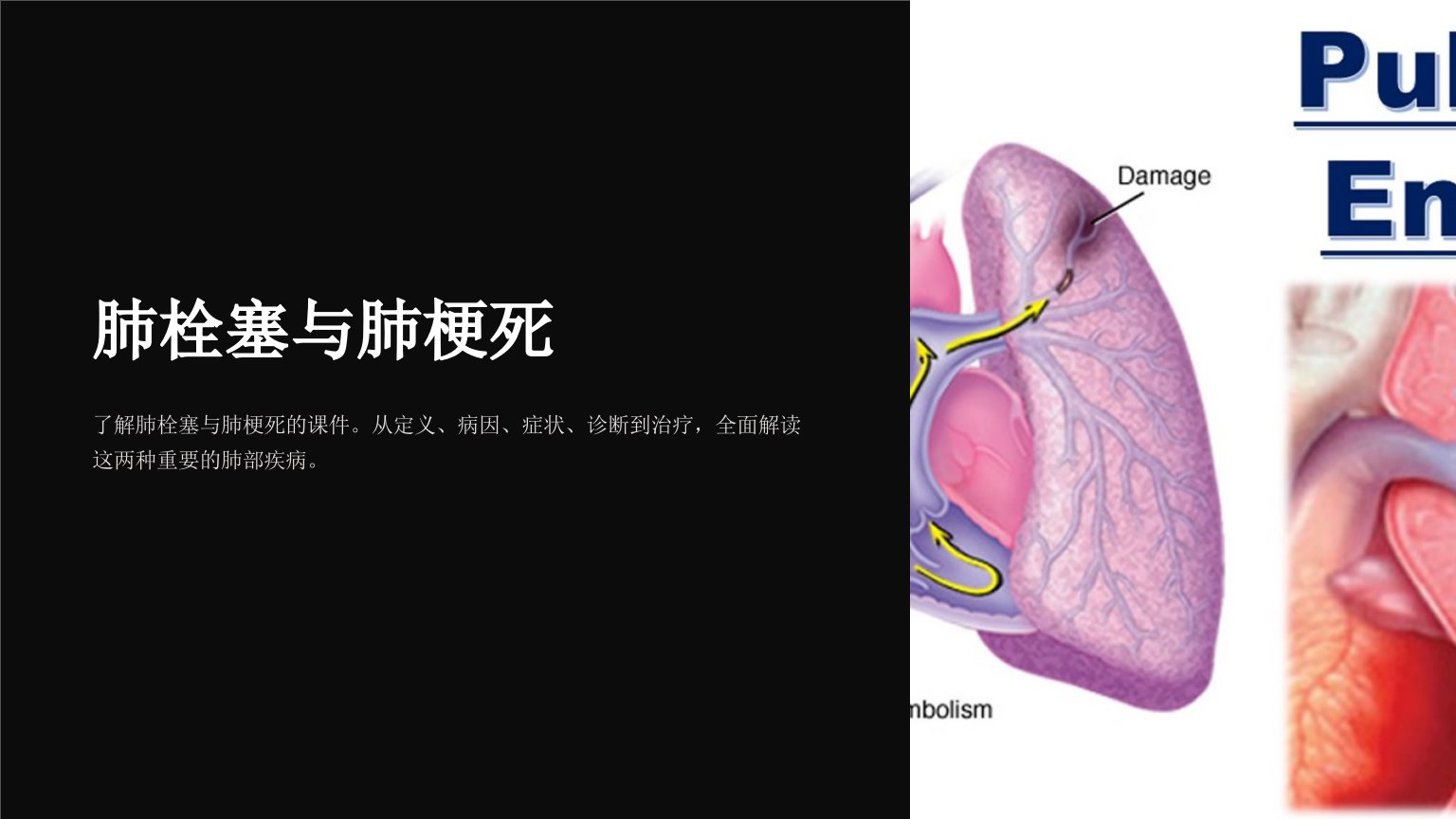 肺栓塞与肺梗死课件