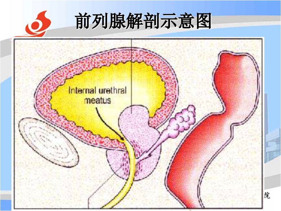 前列腺电切术后并发症的防治培训资料