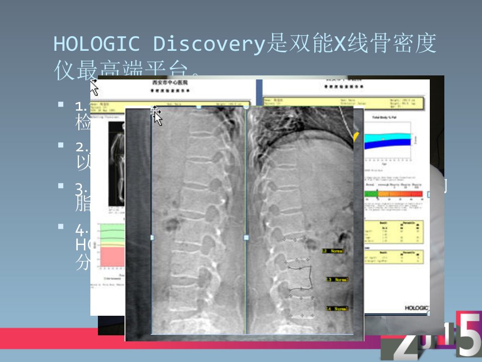 双能x线骨密度仪应用hologicppt课件