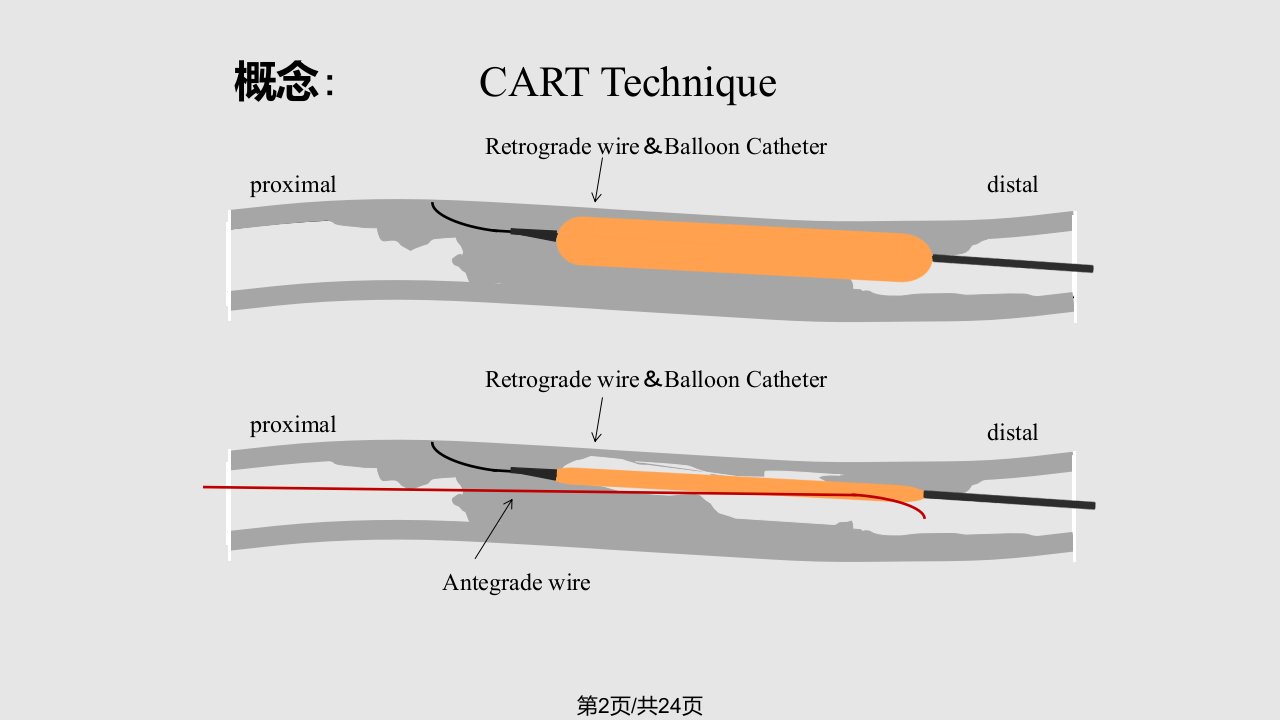 cto病变反向cart技术临床应用金恩泽