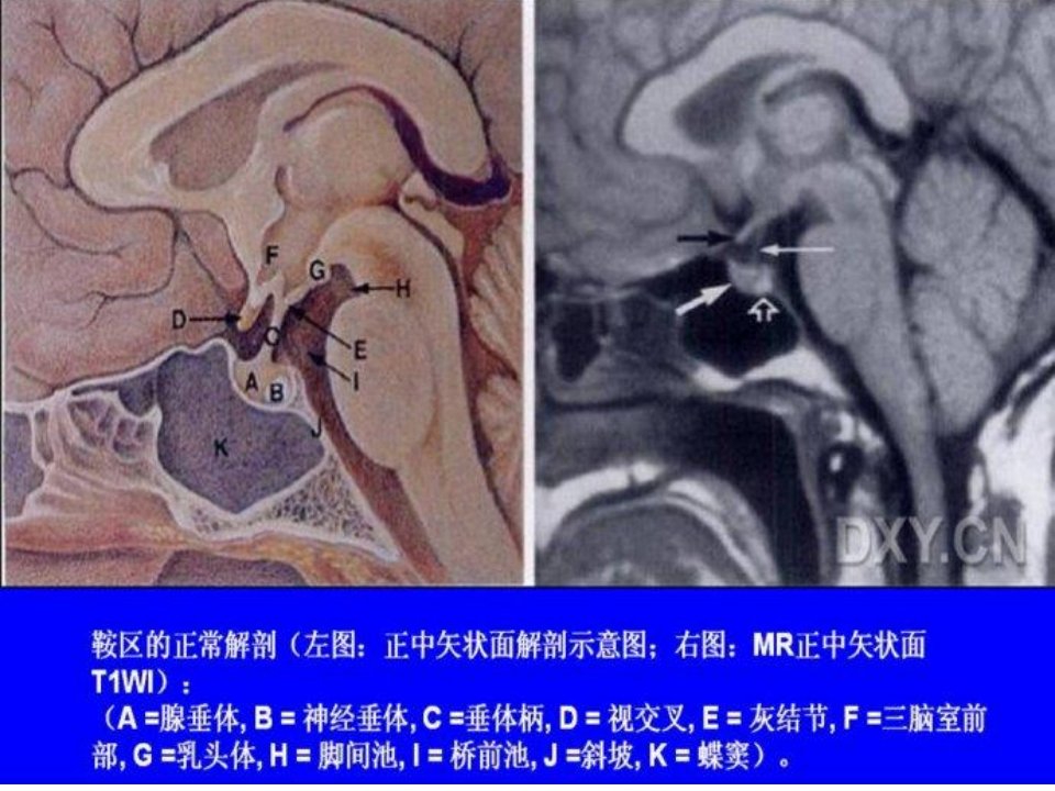 一鞍区常见肿瘤的影像鉴别诊断