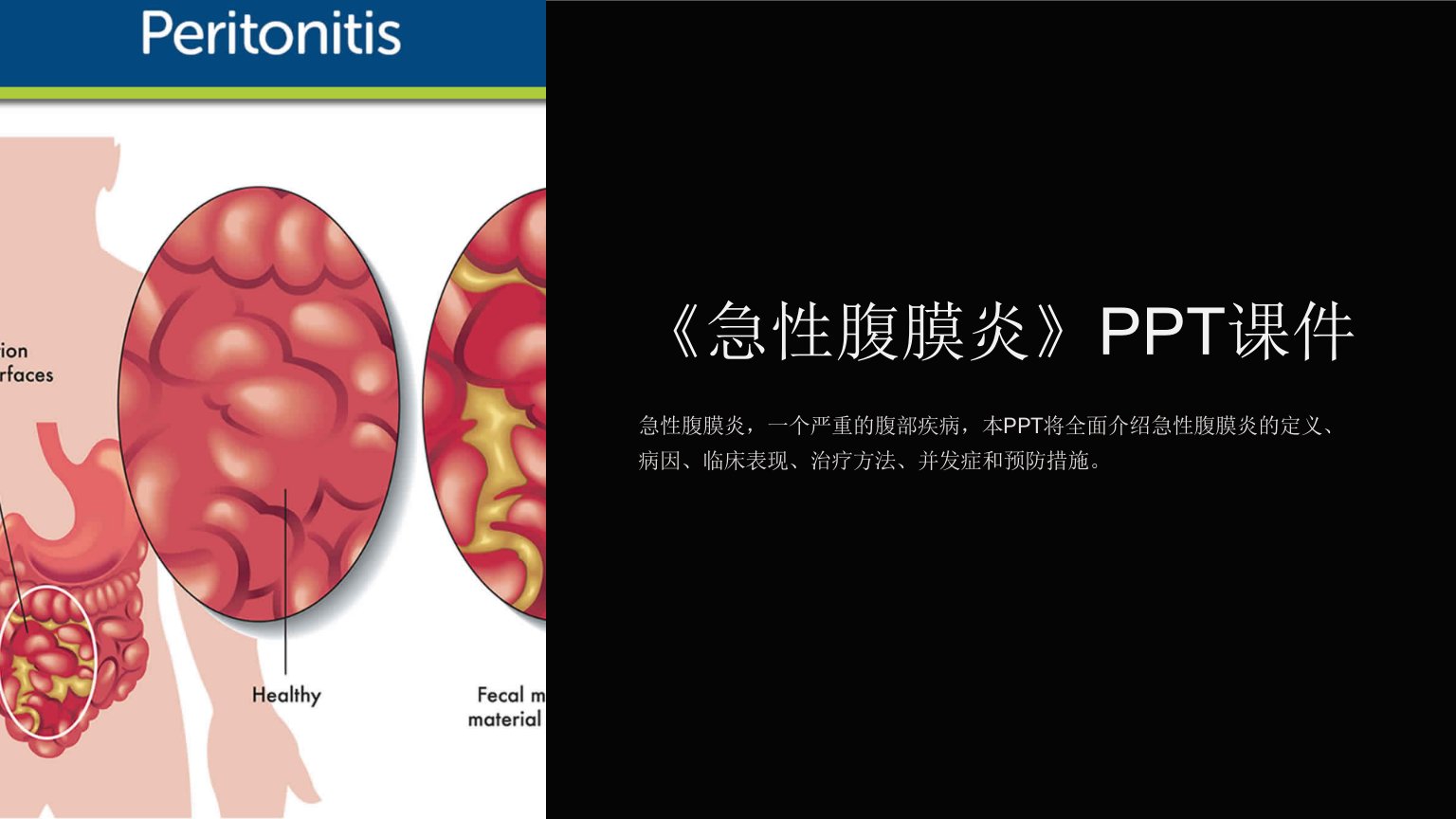 《急性腹膜炎》课件