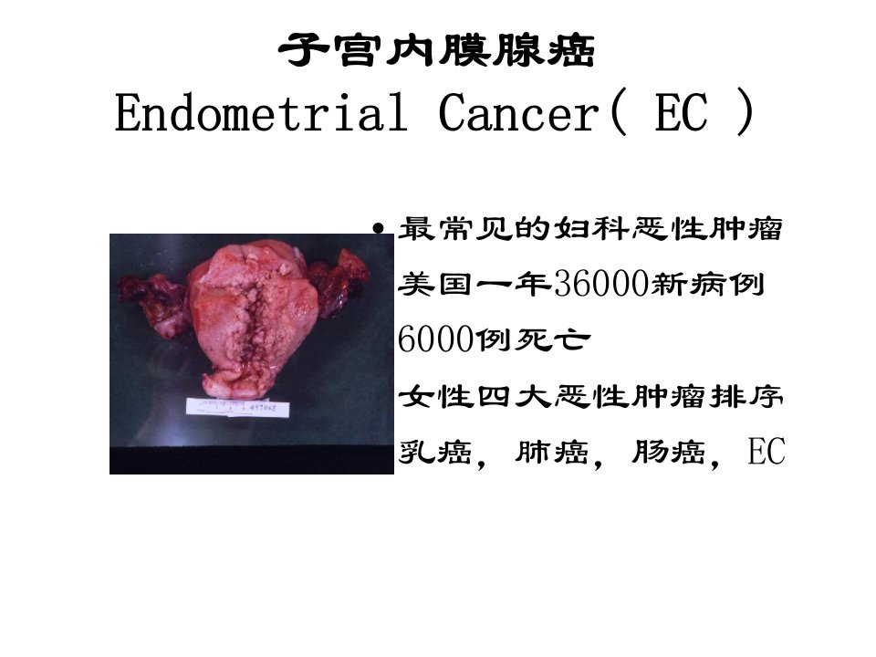 子宫内膜腺癌课件