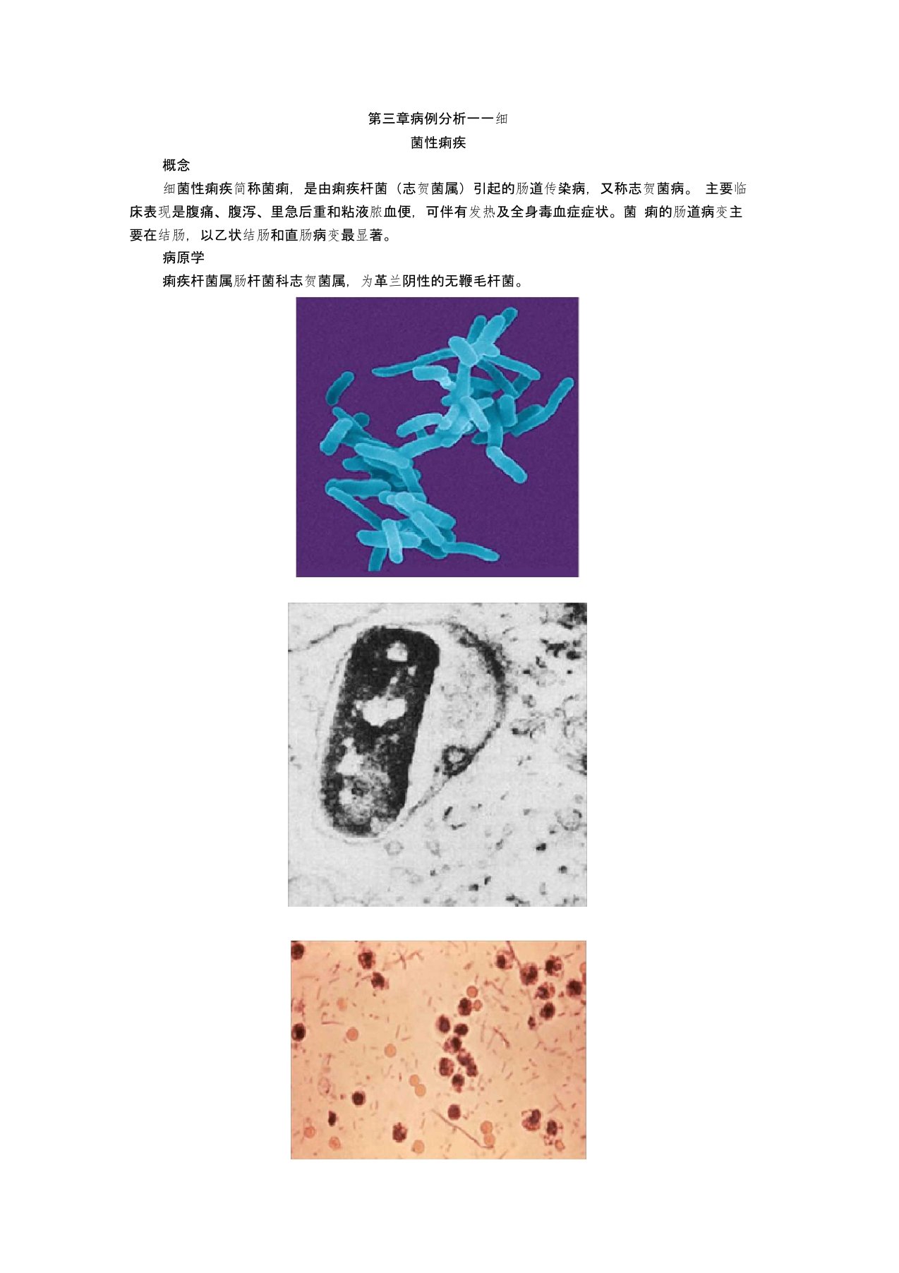 病例分析——细菌性痢疾