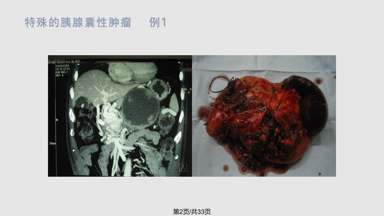 胰腺囊性肿瘤现代外科治疗