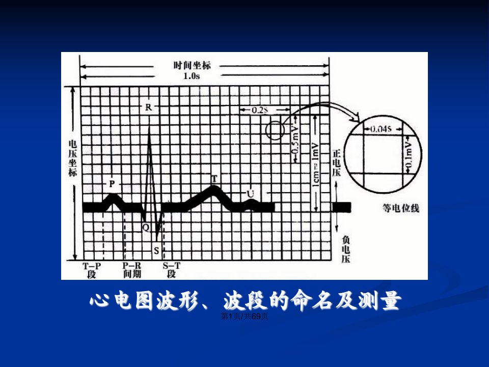 常见异常心电图