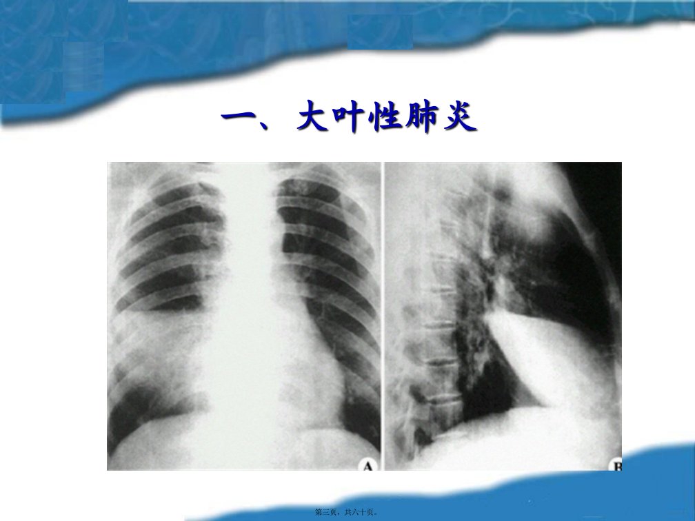 呼吸系统常见症状体征